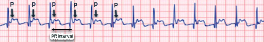 Marked First Degree AV Block