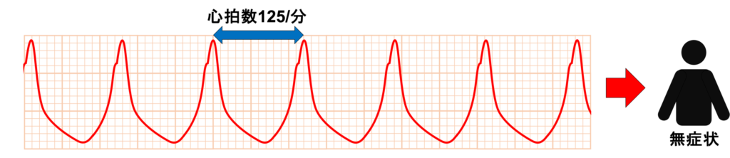 非持続性心室頻拍(Non-sustained ventricular tachycardia: NSVT)