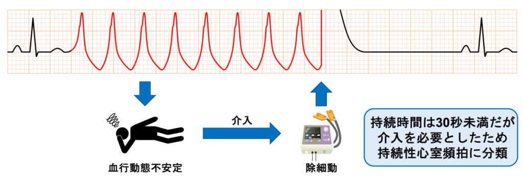 非持続性心室頻拍(Non-sustained ventricular tachycardia: NSVT)