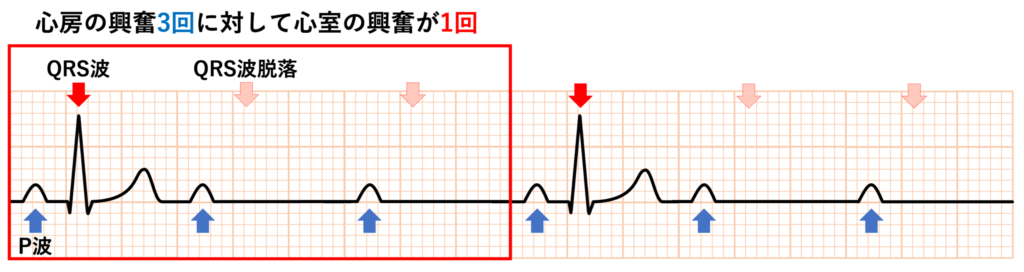 高度房室ブロック(advanced atrioventricular block)