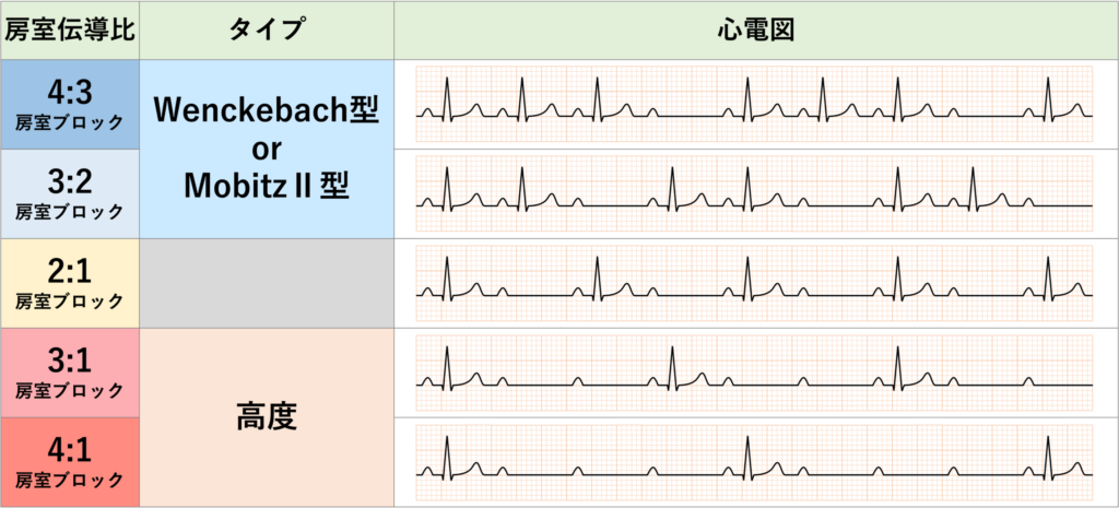 高度房室ブロック(advanced atrioventricular block)