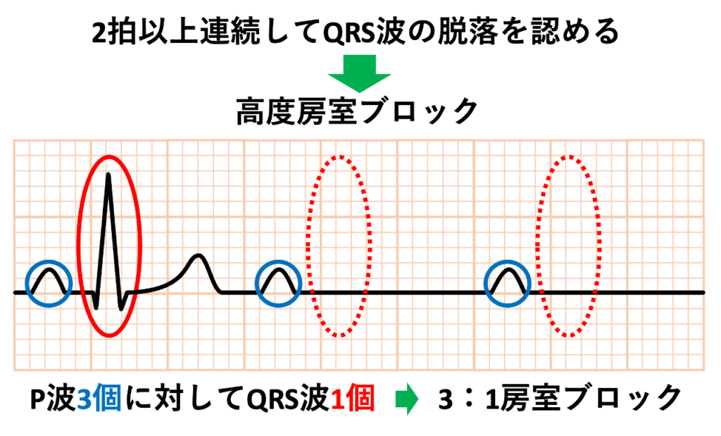 高度房室ブロック(advanced atrioventricular block)