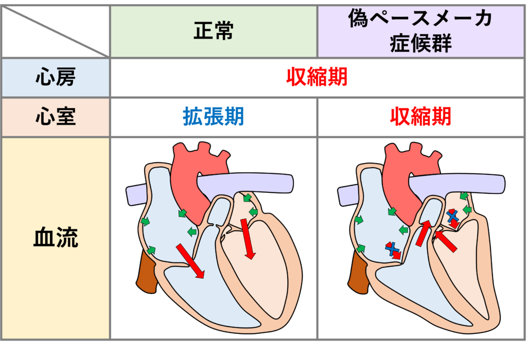 Marked First Degree AV Block
PQ間隔が極端に長い場合には偽ペースメーカ症候群(pseudo-pacemaker syndrome)が生じることがあります。これは実際はペースメーカーが植え込まれていないのに、ペースメーカ症候群(pacemaker syndrome)と同様の血行動態の異常により息切れ、めまい、動悸などの症状が出現する状態を指します