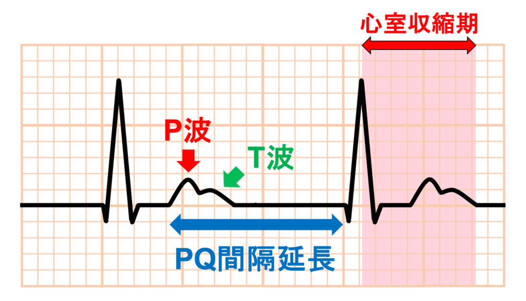 Marked First Degree AV Block
Marked First Degree AV Blockの中でもPQ間隔が極端に長い場合(しばしば400ms以上)には、P波が1つ前のT波に埋もれたり、重なるように出現する場合があります。P波のタイミングが心室の収縮期と重なることになるので偽ペースメーカ症候群に注意が必要です。