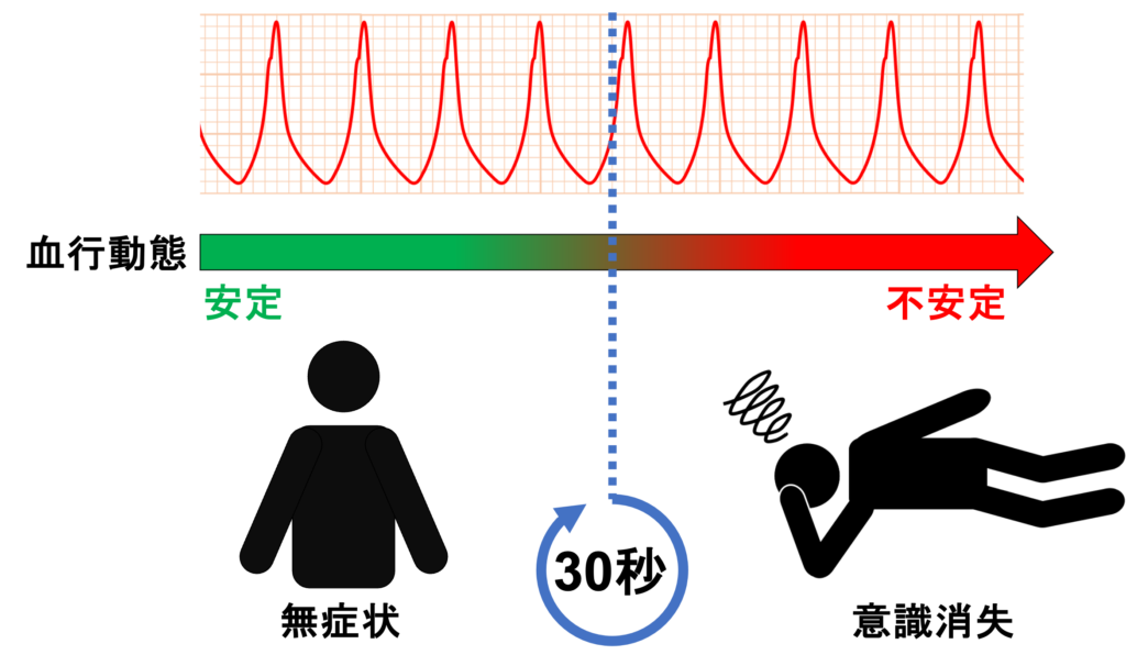 非持続性心室頻拍(Non-sustained ventricular tachycardia: NSVT)