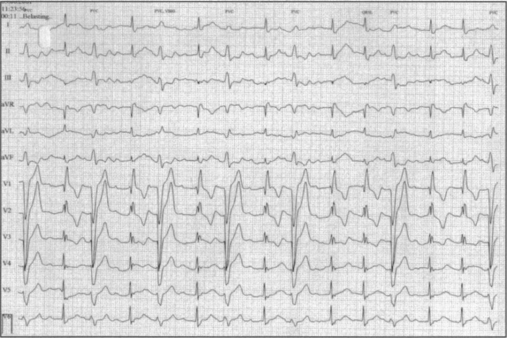 交代性脚ブロック(Alternating bundle branch block)