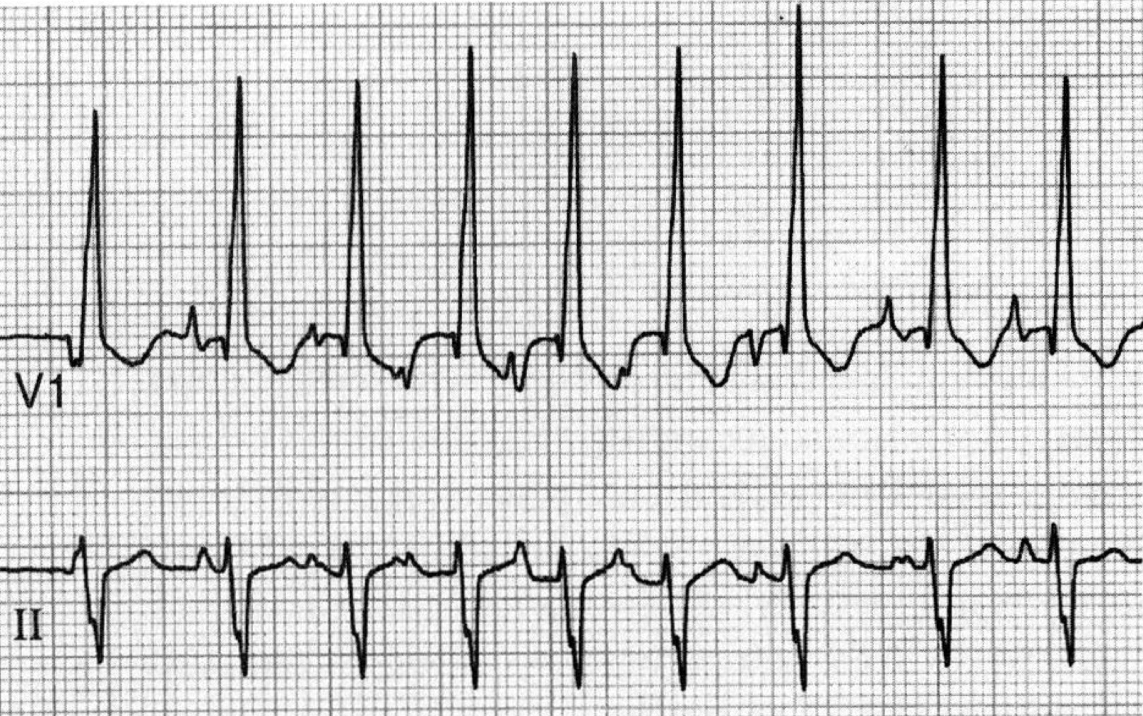 多源性心房頻拍（multifocal atrial tachycardia：MAT）