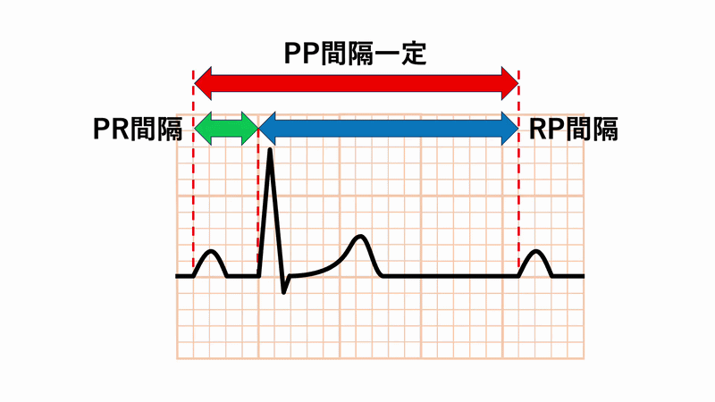 一定の短い周期で興奮が繰り返されると、組織の興奮性が十分に回復せずに相対不応期で次の興奮が到達するため、活動電位の立ち上がり速度が低下して伝導が次第に遅延します。伝導遅延が進行すると、さらに回復時間が不足した状態で次の興奮が到達し、最終的に次の興奮の到達時点が有効不応期に重なり興奮が伝導できない拍が生じます。この進行性の伝導遅延と最終的な伝導ブロックがWenckebach現象です。