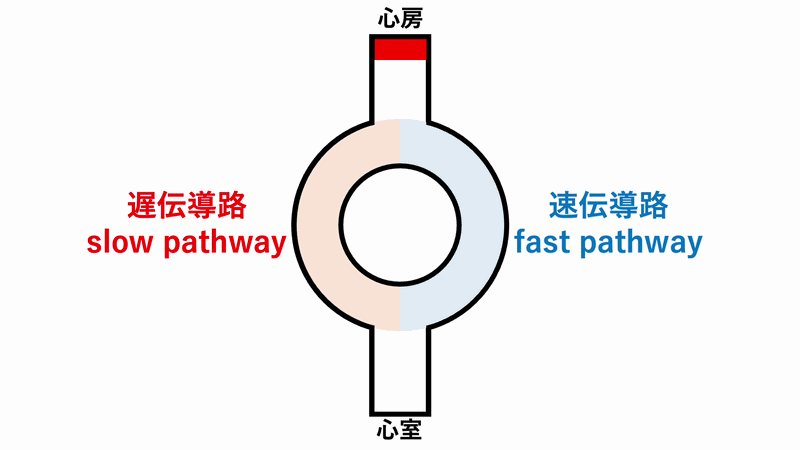 房室結節回帰性頻拍(atrioventricular nodal reentrant tachycardia:AVNRT)