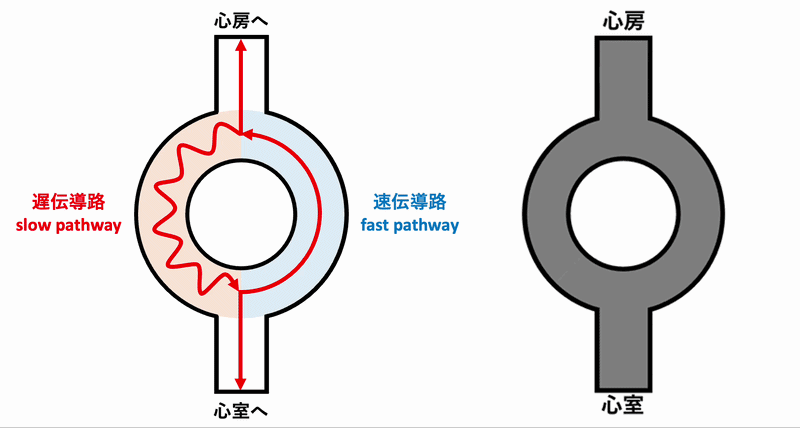 房室結節回帰性頻拍(atrioventricular nodal reentrant tachycardia:AVNRT)