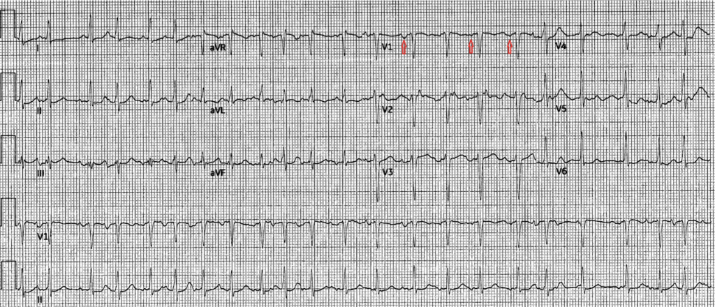 多源性心房頻拍(multifocal atrial tachycardia：MAT)