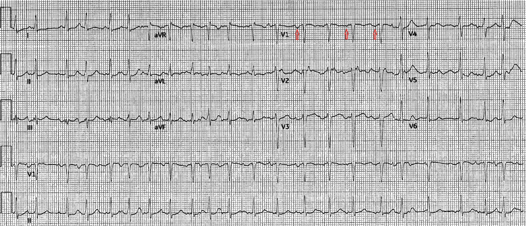 多源性心房頻拍(multifocal atrial tachycardia：MAT)