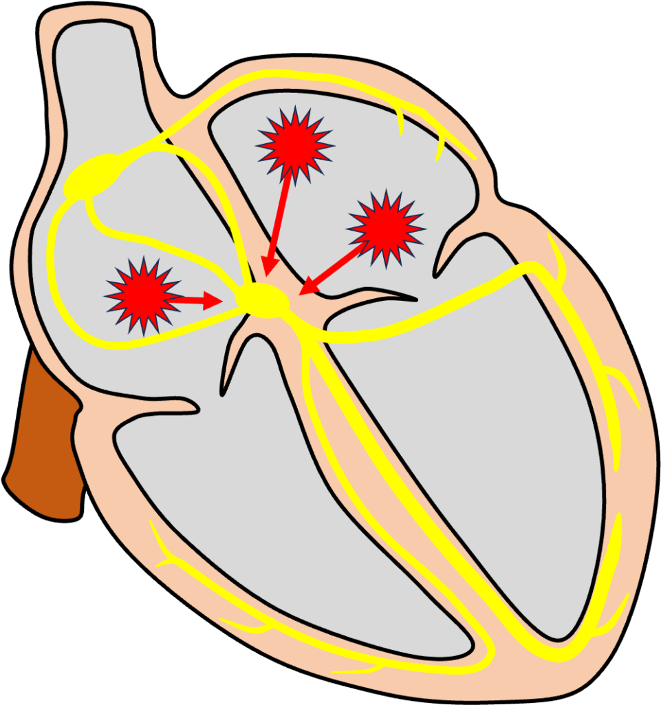 多源性心房頻拍(multifocal atrial tachycardia：MAT)
多源性心房頻拍は心房内の洞結節以外の複数の場所で興奮が発生して頻拍となっている状態です。