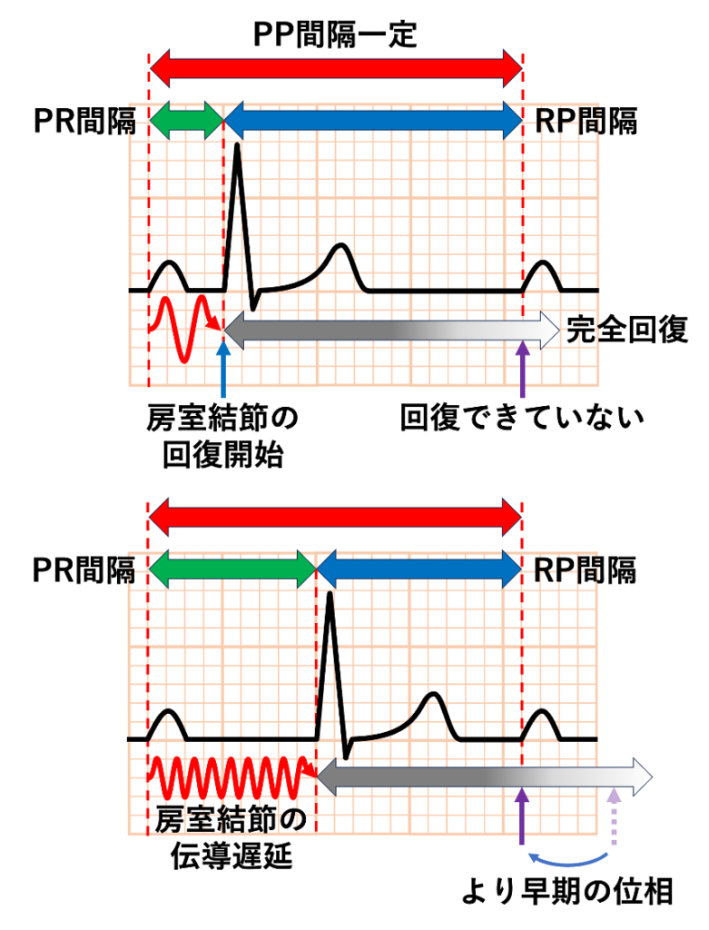 Wenckebach現象(Wenckebach phenomenon)
回復時間とは、次の興奮が到達するまでに組織が回復に利用できる時間、すなわち与えられた「休み時間」と考えることができます。完全回復に必要な時間が大きく変わらないとすれば、次の興奮までに与えられる時間が拍ごとに短くなることで、組織は徐々に回復しきれない状態で次の興奮を迎えることになります。回復に利用できる時間は心電図上のRP間隔におおむね相当すると考えることができるため、PQ(PR)間隔が拍ごとに延長すると、一定のPP間隔の中で次のP波までに残されるRP間隔は次第に短縮します。その結果、次の興奮が回復過程のより早い位相で到達するため、伝導がさらに遅延し、最終的にQRS波が脱落します。