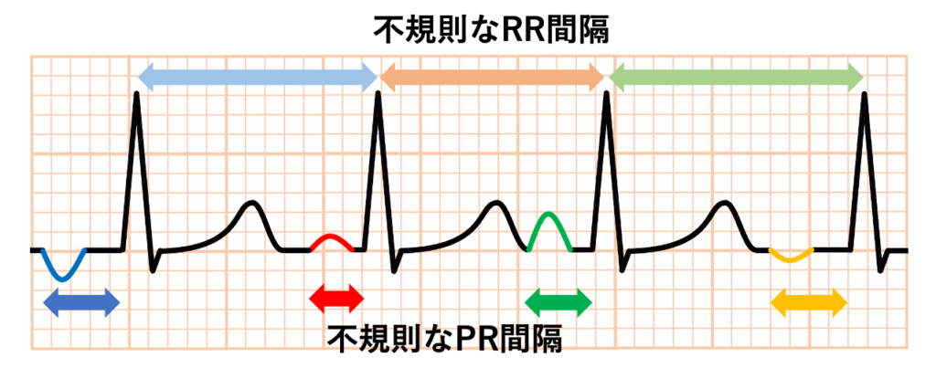 多源性心房頻拍（multifocal atrial tachycardia：MAT）
一般的に見られますが診断基準に含まれない所見として、不規則なPR間隔とRR間隔があります。多源性心房頻拍では複数の興奮起源が別々の周期で発火するためRR間隔(PP間隔も同様)が不整になり、各起源から房室結節までの距離・経路が違うためPR間隔も不整になります。