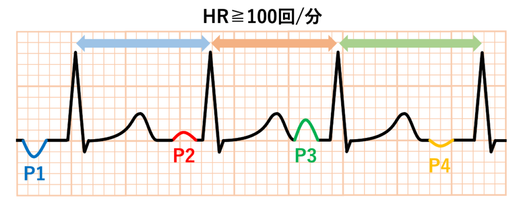多源性心房頻拍(multifocal atrial tachycardia：MAT)