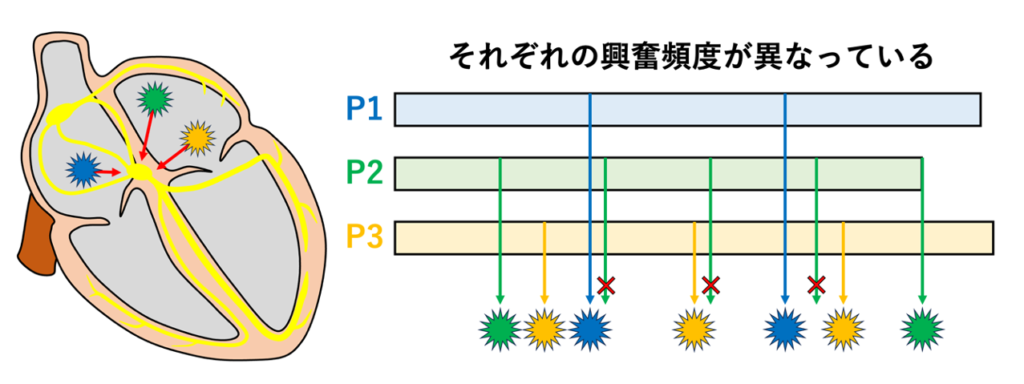 多源性心房頻拍(multifocal atrial tachycardia：MAT)
洞結節や通常の潜在ペースメーカでは、最も速い部位からの興奮が他の自動能部位をリセットするため、通常は単一のペースメーカ部位が優位となります。これに対して多源性心房頻拍では、心房内の複数部位で自動能の亢進やtriggered activityが生じ(リエントリーの関与も提案されている)、単一のペースメーカによる支配が成立しにくくなります。その結果、複数の心房焦点が興奮の起源となり、P波形態、PP間隔、PR間隔が不規則に変化します。