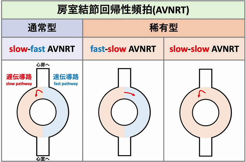 房室結節回帰性頻拍(atrioventricular nodal reentrant tachycardia:AVNRT)