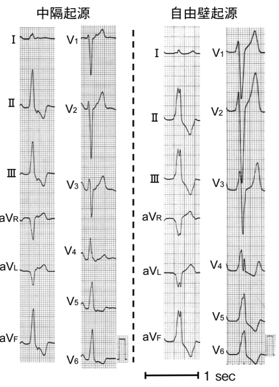 Pvc Rvot Map Carto 右室流出路起源心室期外収縮とは? | 心電図.com