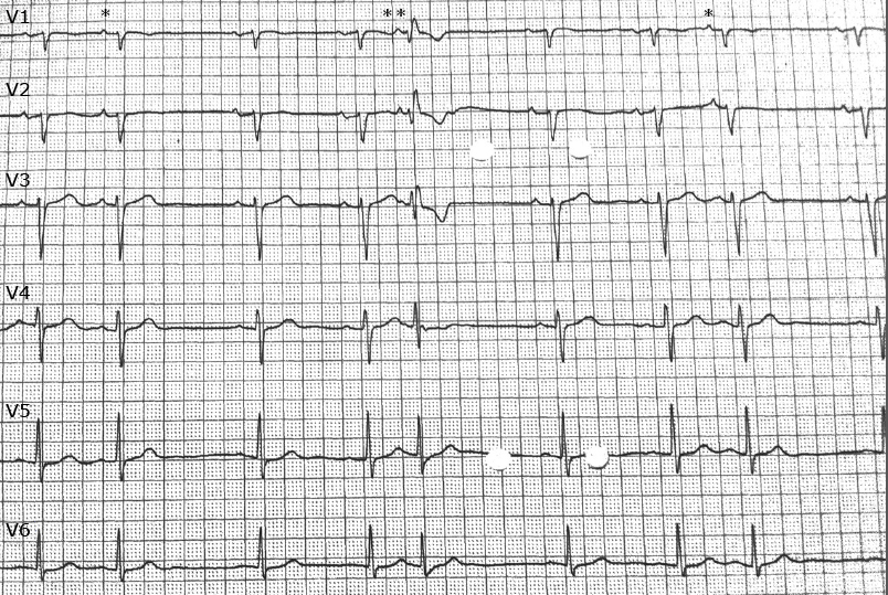 通常の心房期外収縮と:変行伝導を伴う心房期外収縮