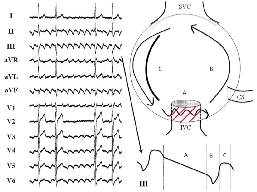 典型的な反時計回りの心房粗動　(A)プラトー期（三尖弁下大静脈間峡部における伝導）(B)中隔壁の上行性伝導　(C)側壁の下行性伝導　CS：冠状動脈洞；IVC：下大静脈；SVC：上大静脈