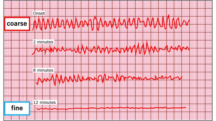 心電図は時間経過に伴いcoarse VFからfine VFへ移行する様子