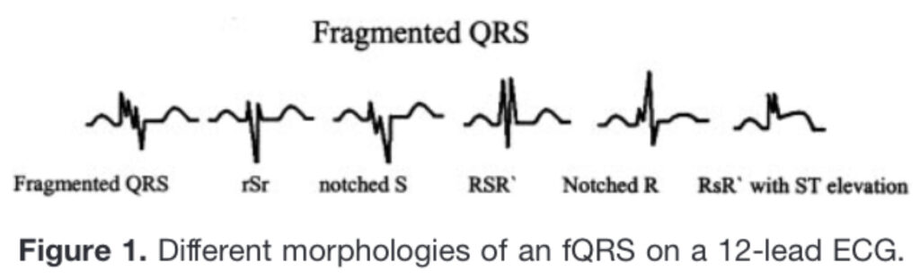 fQRS(fragmented QRS)