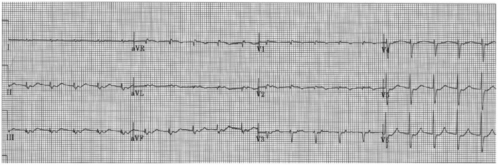 右側胸水と末梢浮腫の患者の心電図。四肢誘導とV1～V3誘導でQRS電位が低下