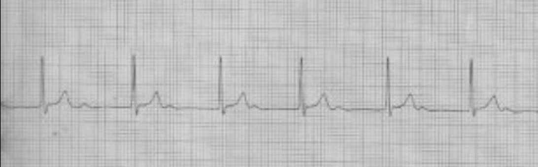 Marked First Degree AV Block 