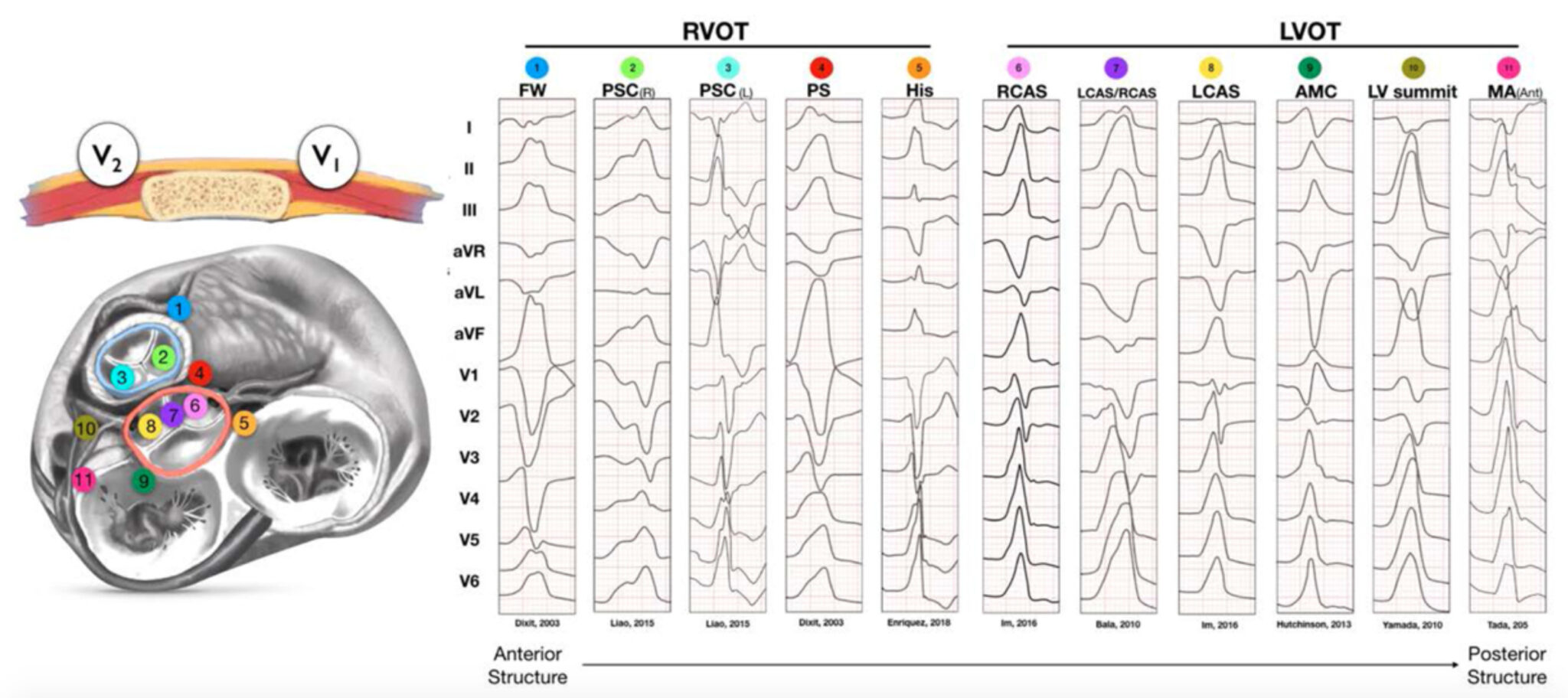 流出路起源心室性不整脈とは? 流出路起源心室性不整脈とは?
