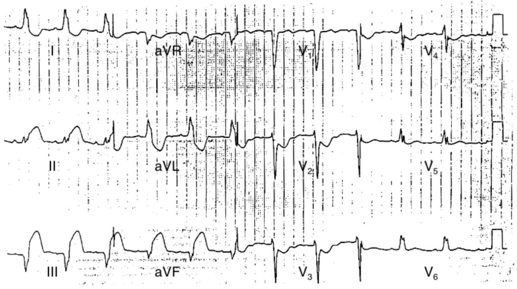 上の心電図ではQRSと一致する1mm以上のST上昇（II誘導）、V2・V3での1mm以上のST低下、QRSと一致しない5mm以上のST上昇（III誘導およびaVF）が見られます。