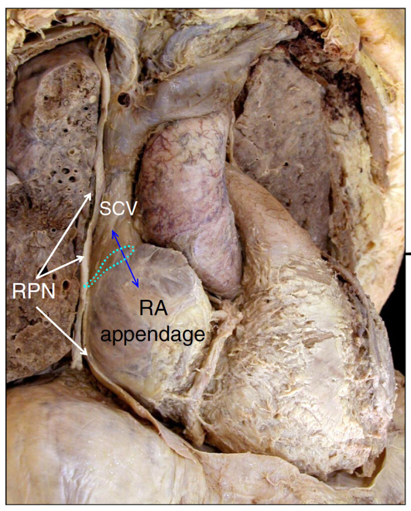 心臓の正面図　RPN:右横隔神経、SCV:上大静脈、RA appendage:右心耳、青点線:洞結節
