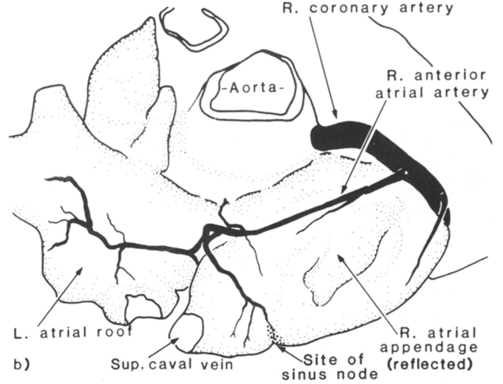 右前心房動脈起源の洞房結節動脈