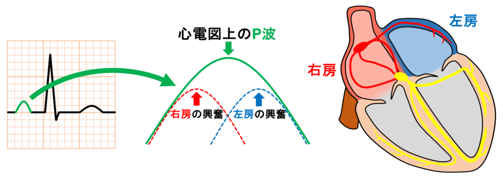 僧帽性P波(P mitrale)