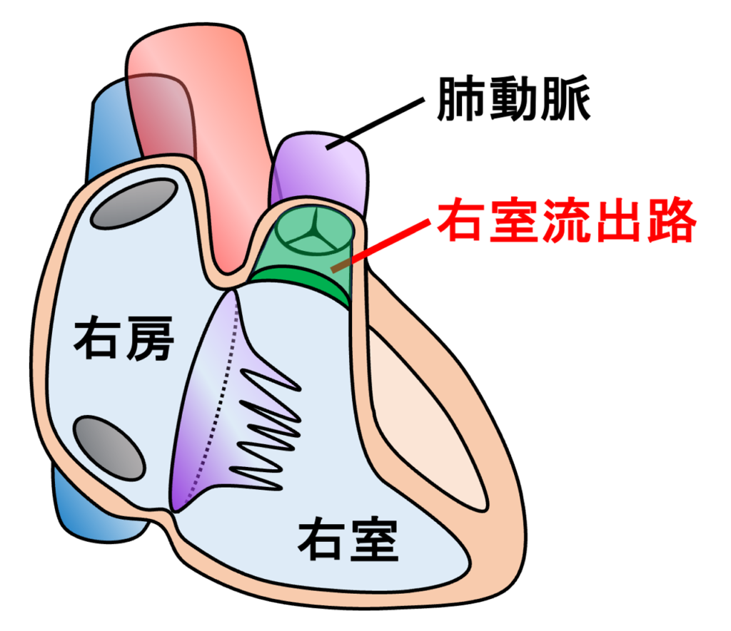 右室流出路起源