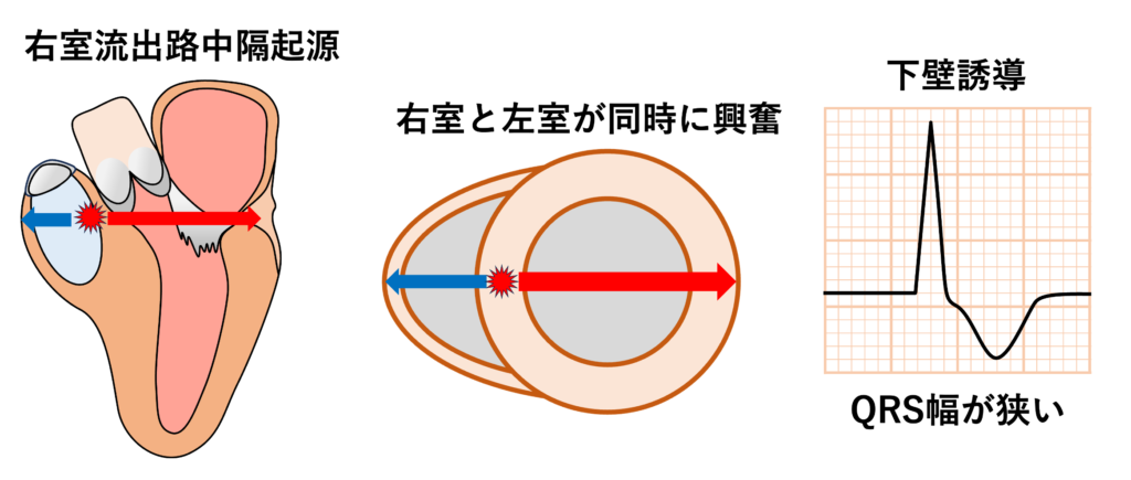 右室流出路起源