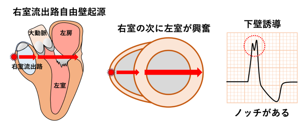 右室流出路起源