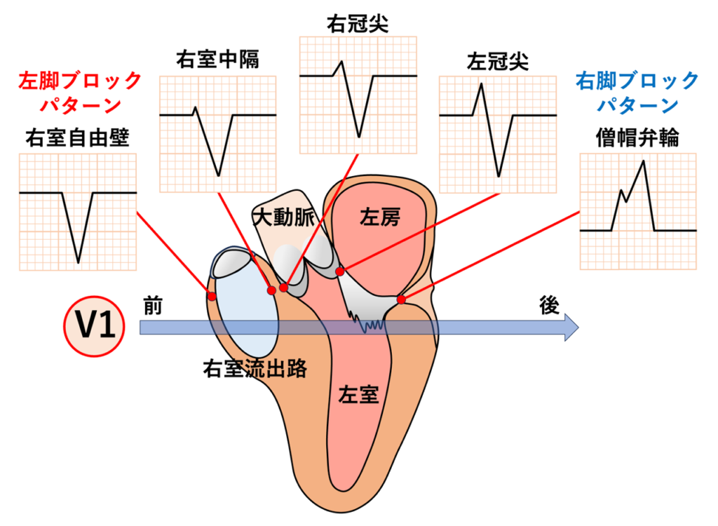 右室流出路起源