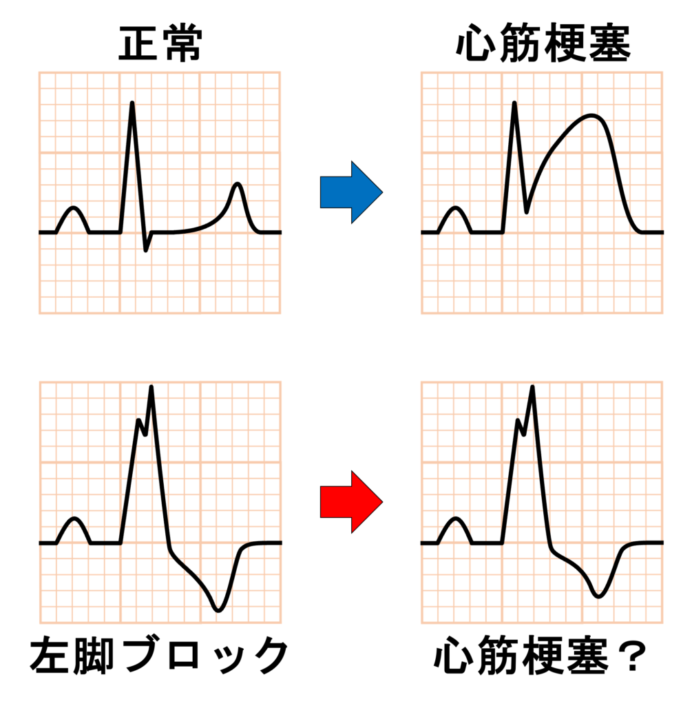 Chapman's sign
左脚ブロックや右室ペーシングがある場合、二次性ST-T変化により心筋梗塞のST変化が隠れてしまい診断が難しくなります。Chapman’s signは、こうした状況で心筋梗塞の存在を示唆する所見として提唱されました。