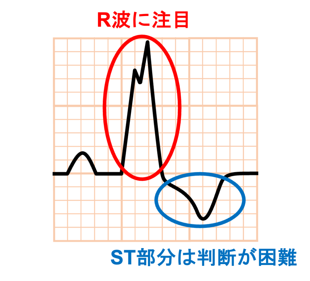 Chapman's sign
Chapman’s signは判断の難しいST部分ではなく、QRS波の形状に着目しています。左脚ブロックのみでは生じない、心筋梗塞由来のR波の波形変化を捉えています。
