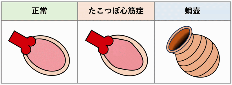 たこつぼ心筋症(Takotsubo Cardiomyopathy)
