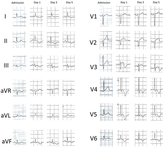 たこつぼ心筋症(Takotsubo Cardiomyopathy)