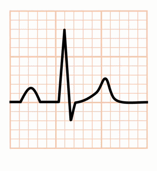 たこつぼ心筋症(Takotsubo Cardiomyopathy)