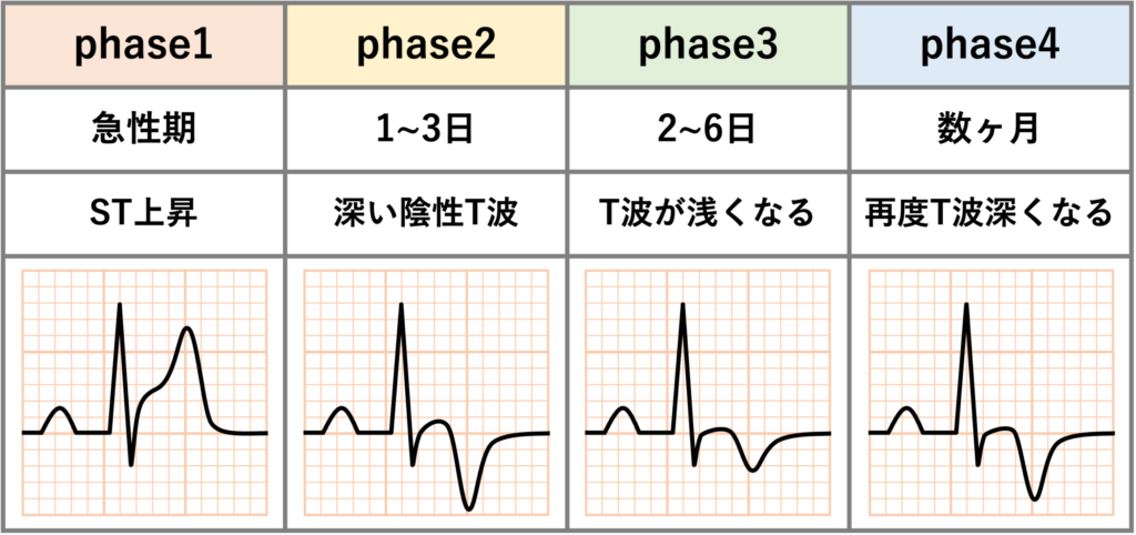 たこつぼ心筋症(Takotsubo Cardiomyopathy)
たこつぼ心筋症の心電図は時間的変化が見られます。4相性の変化が報告されており、急性期にST上昇し、発症1〜3日で陰性T波の最初のピークを認め、発症2〜6日に陰性T波が一時的に浅くなり、その後再び陰性T波が深くなり数ヶ月程度持続します。