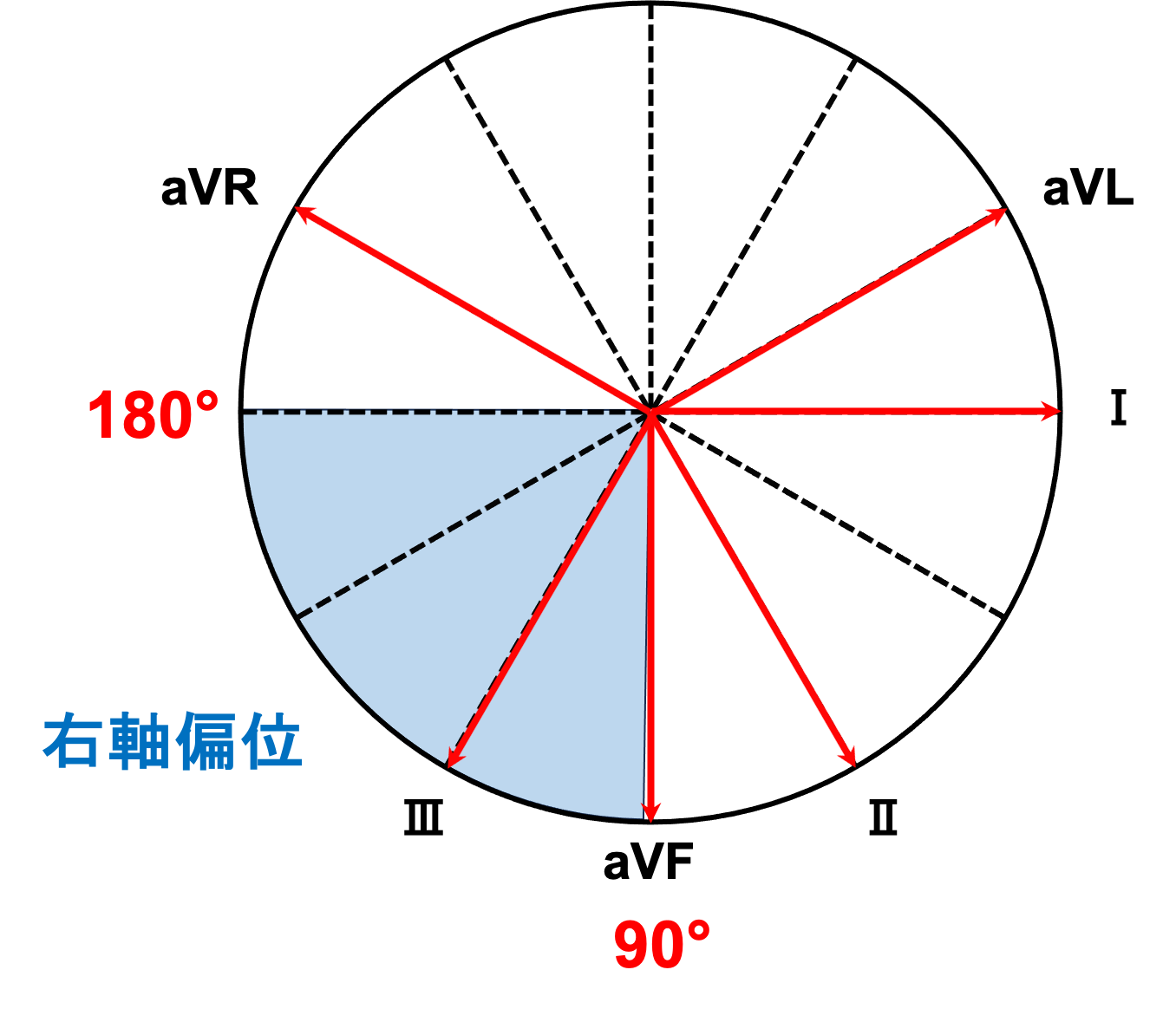 右軸偏位とは？ | 心電図.com