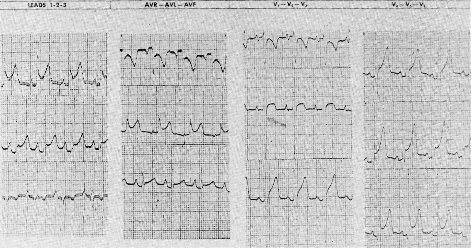 医師は結核性心膜炎をどのように診断しますか?