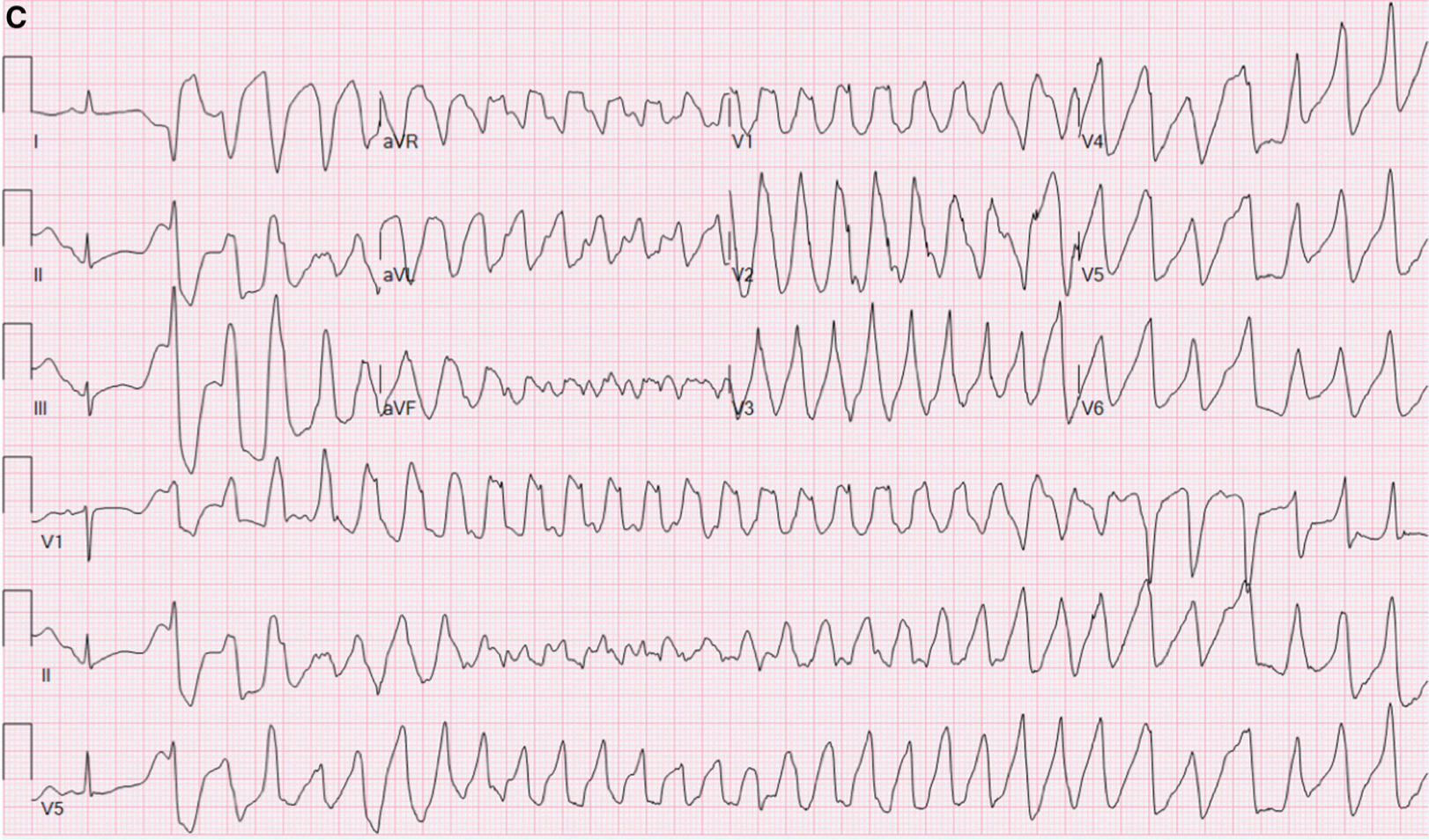 心停止のリスクを軽減するにはどうすればよいですか?