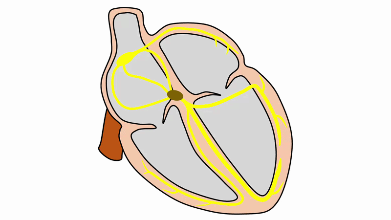 Wenckebach型Ⅱ度房室ブロック(Wenckebach second degree atrioventricular block)