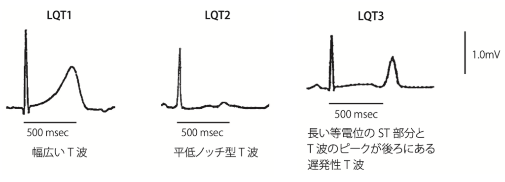 LQTSの原因は何ですか?