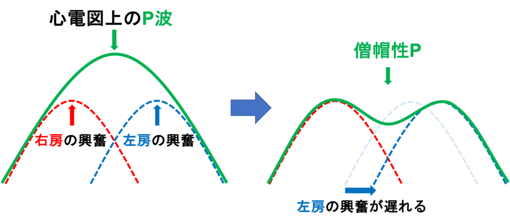 左房負荷によって左房が拡大すると、左房の興奮が遅れるためP波の持続時間が延長します。左房の興奮の頂点も後ろにずれるため二峰性のP波となります。